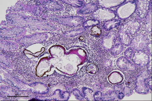 Transverse and tangential sections of hepatopancreas tubules with melanization and obliteration of tubules, infiltration of hemocytes associated with the tubules and in hemal spaces.